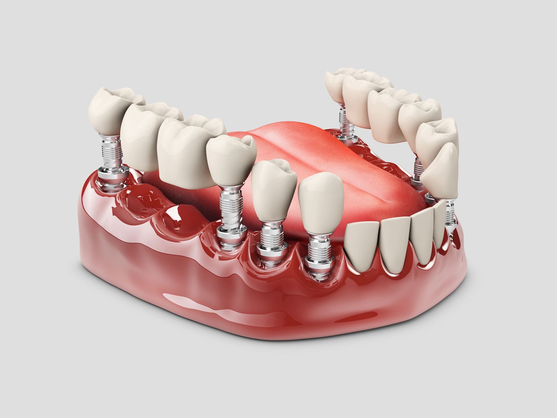 model of dental implant bridges