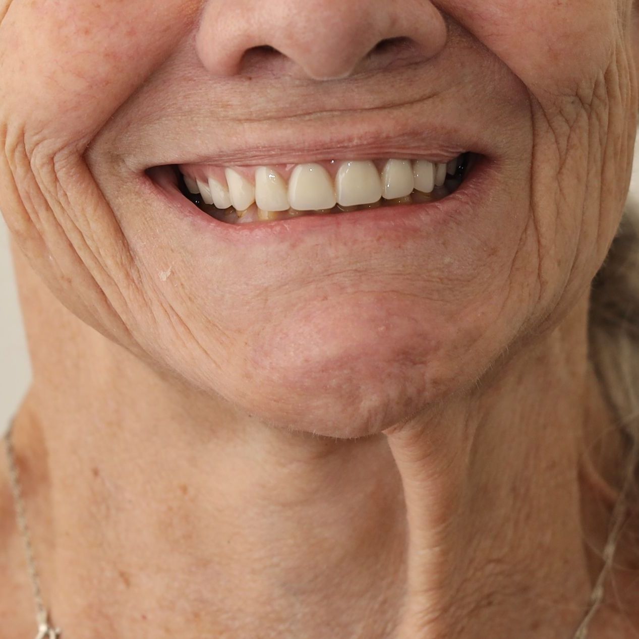 A close up of a person's mouth with their teeth showing after treatment.