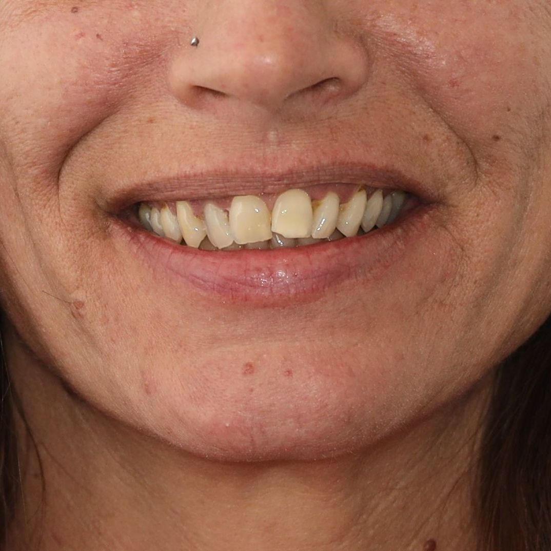 A close up of a person's mouth with their teeth showing before treatment.