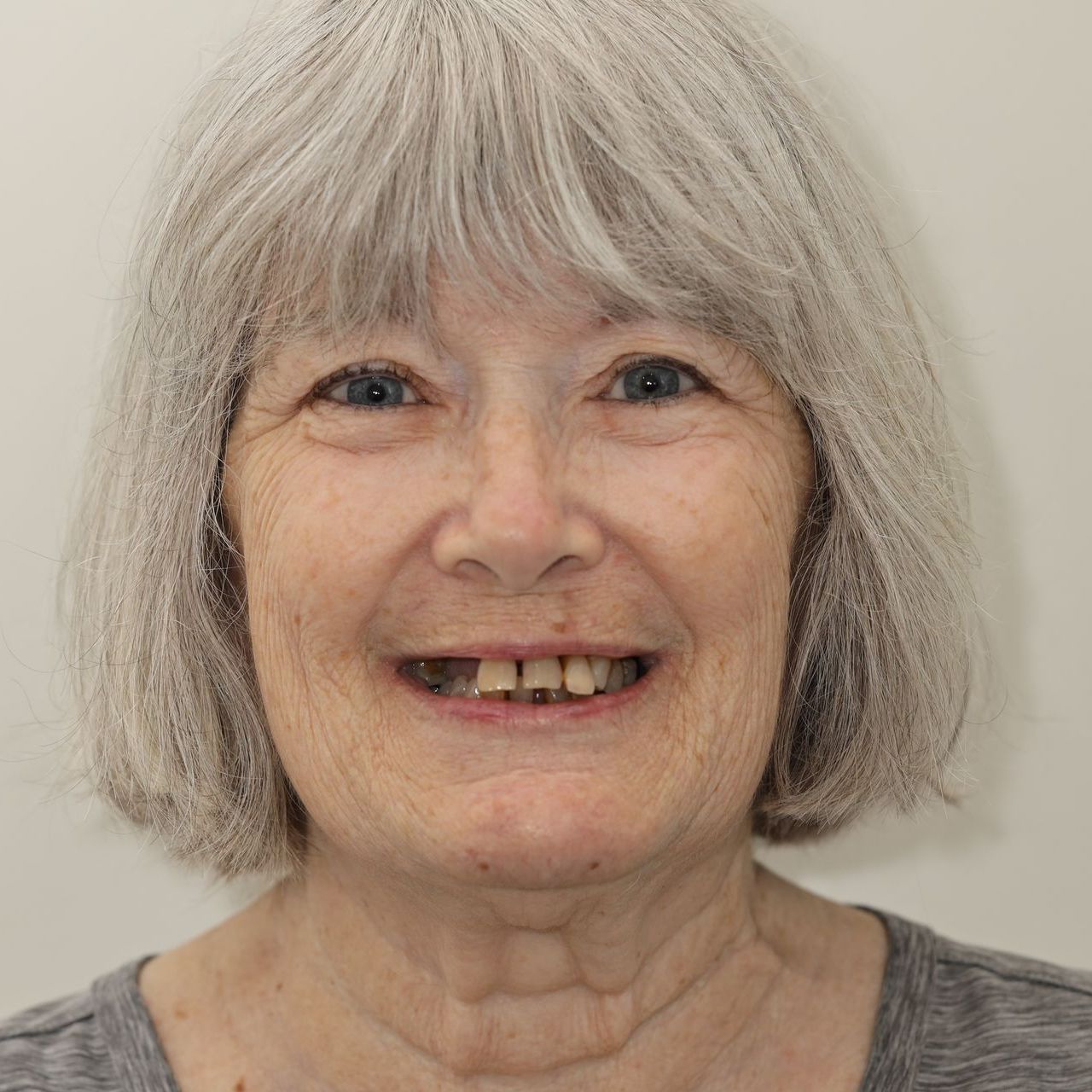 A close up of a person's mouth with their teeth showing before treatment.