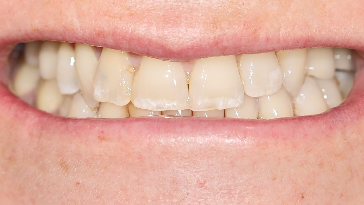 A close up of a person's mouth with their teeth showing after treatment.