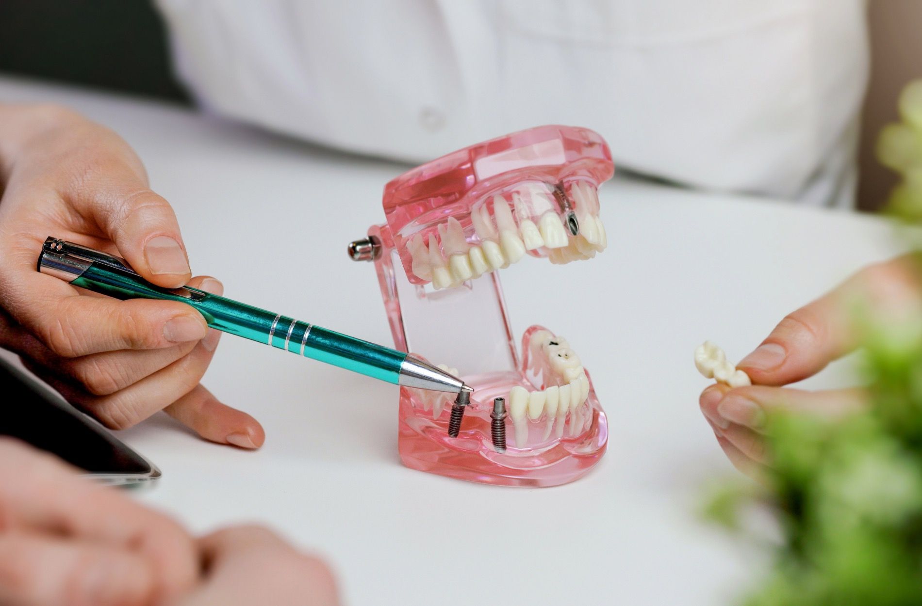 dental implant