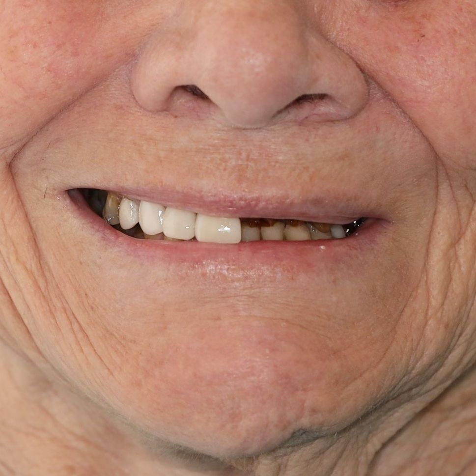 A close up of a person's mouth with their teeth showing before treatment.