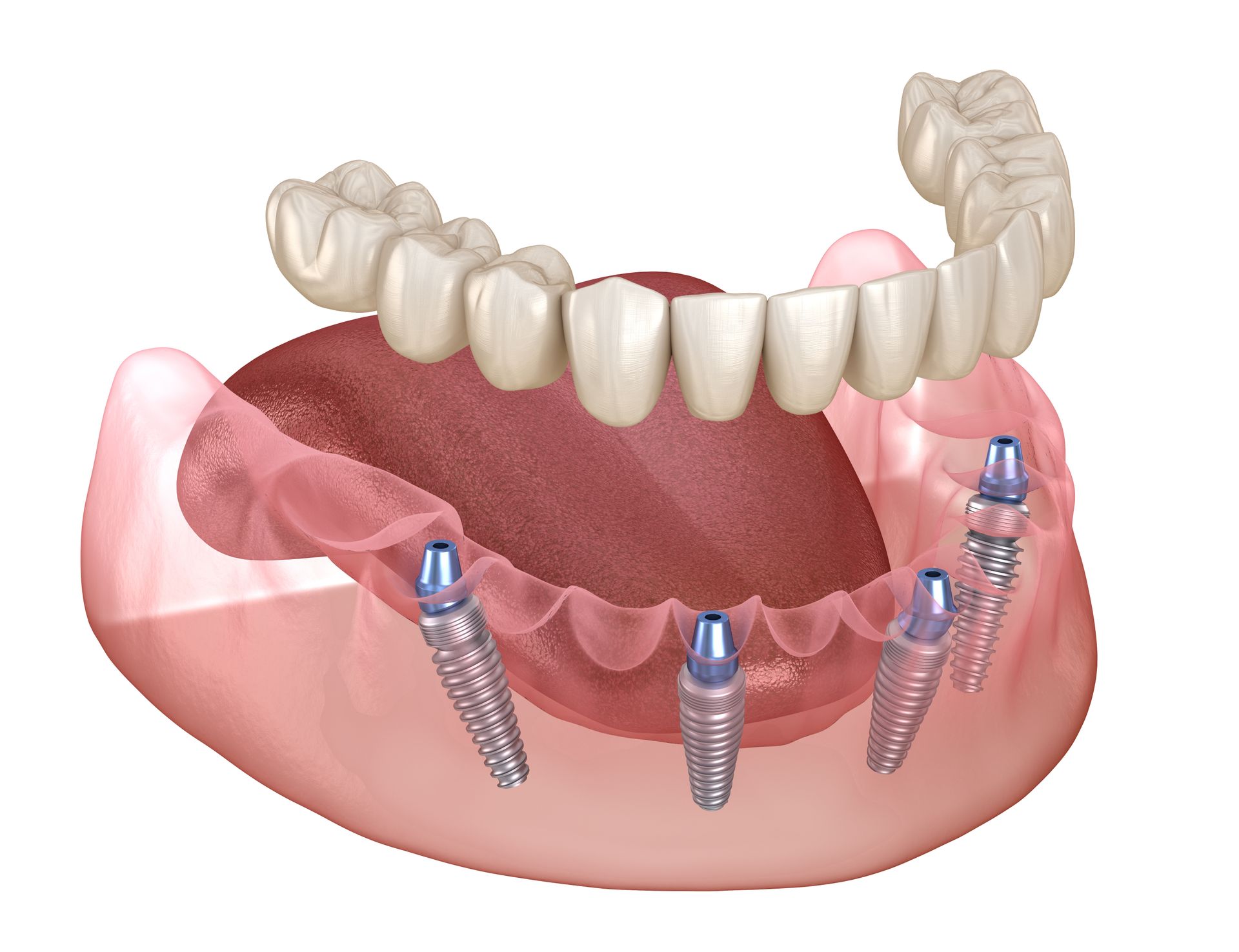 model of an all-on-4 fixed dental implants
