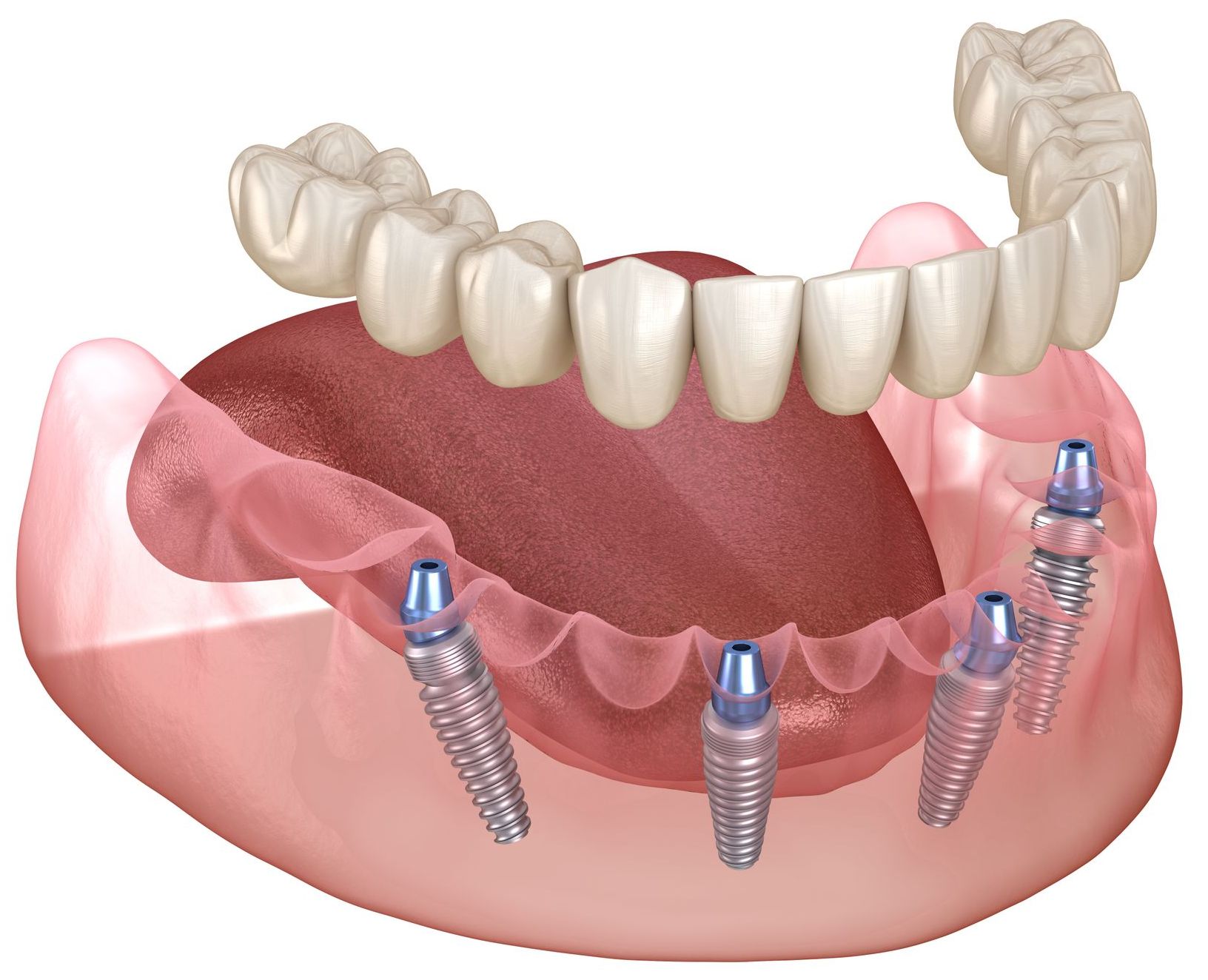 model of fixed dentures