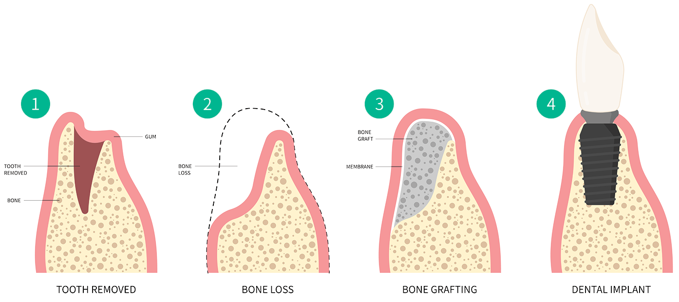 graphic showing the process of bone grafting 4 steps including tooth removed, bone loss, bone grafting and dental implant