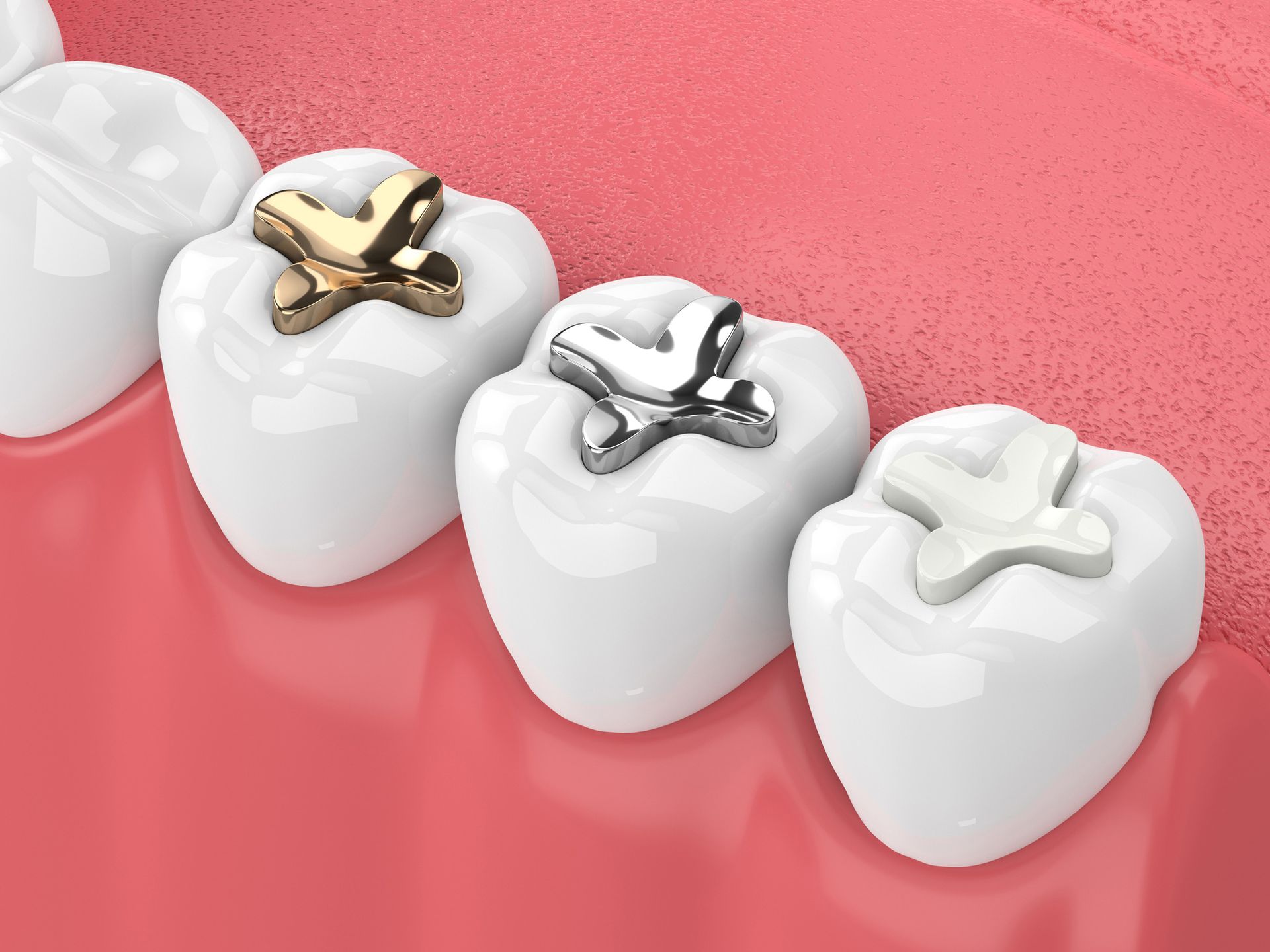 Three teeth with dental fillings in gold, silver, and white, set in a pink gum line.