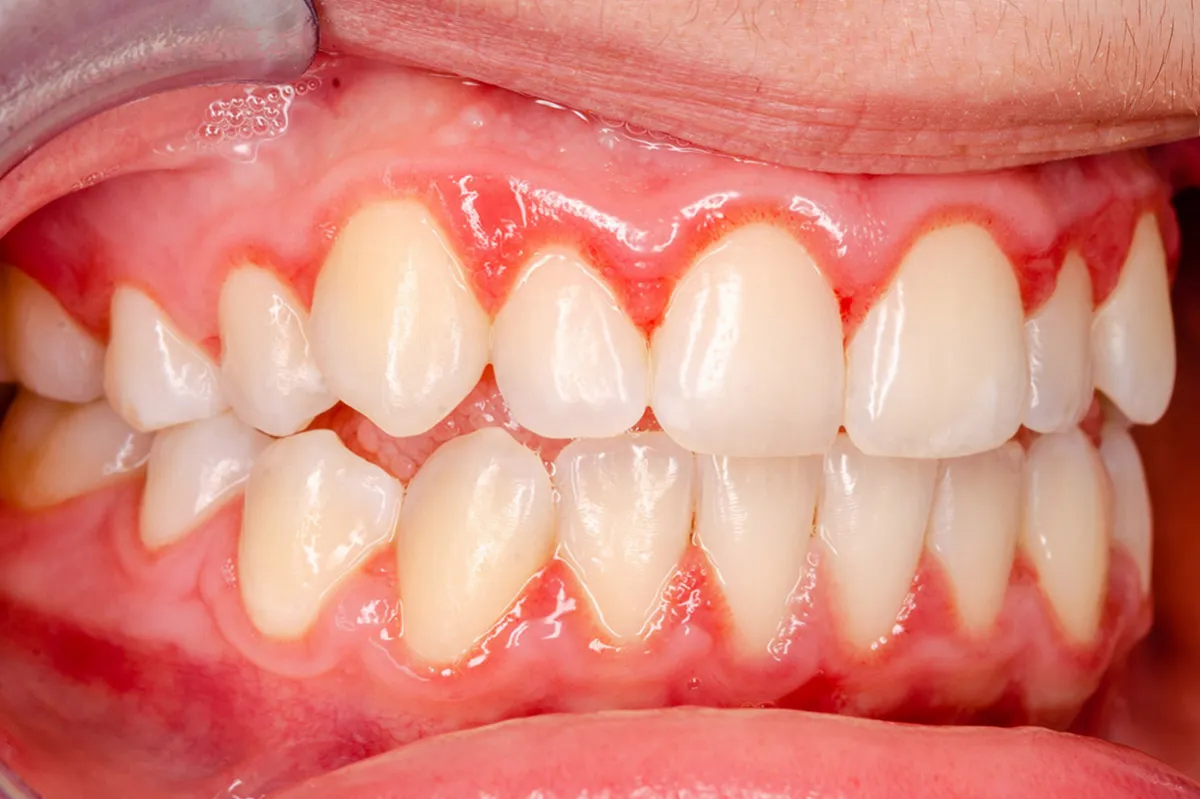 Periodontal Disease