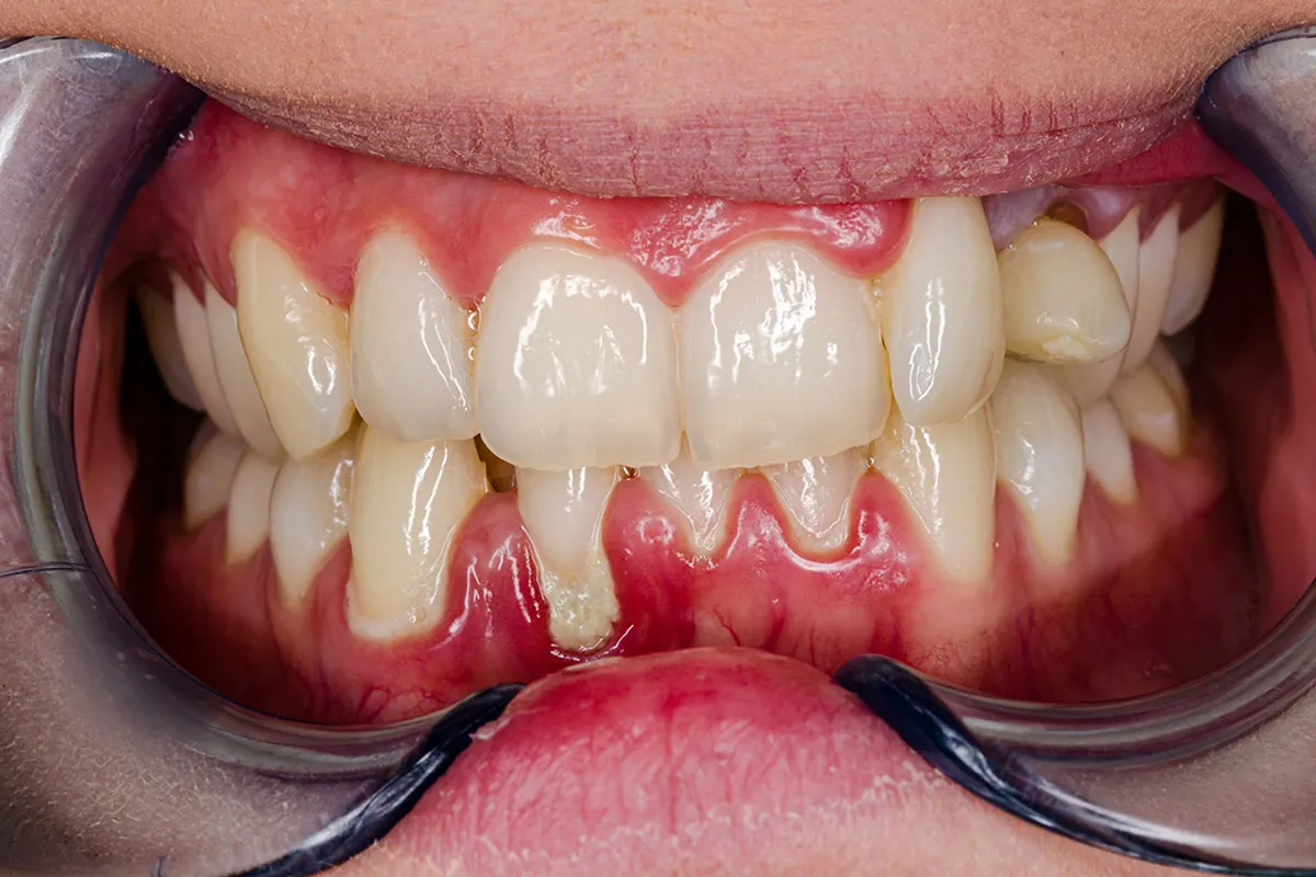 Mouth open, teeth visible with red gums, dental retractor in place.