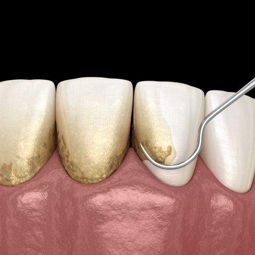 fix chipped front tooth