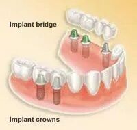 Implant bridge - Implant crowns