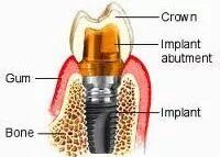 Dental Implants Parts