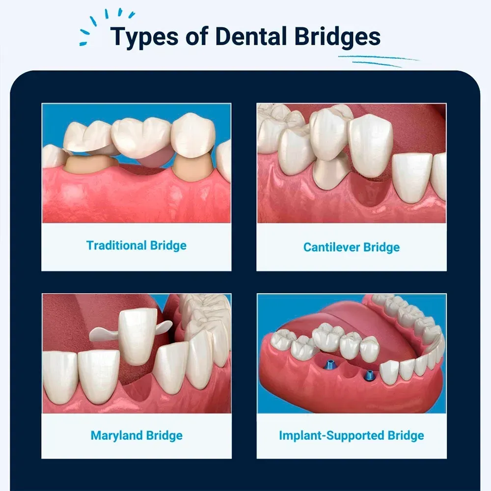 Types of dental bridges. Illustrations show traditional, cantilever, Maryland, and implant-supported bridge configurations.