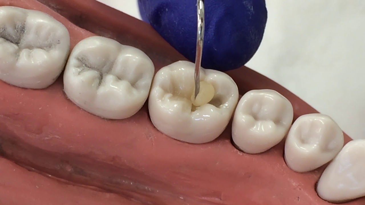 Dentist probing a tooth with a cavity, inside a model of the mouth.