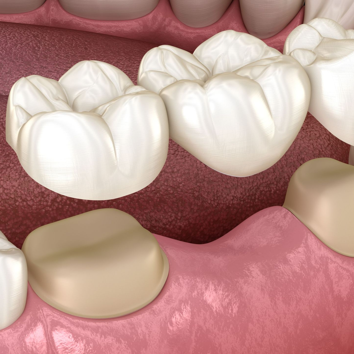 fix chipped front tooth
