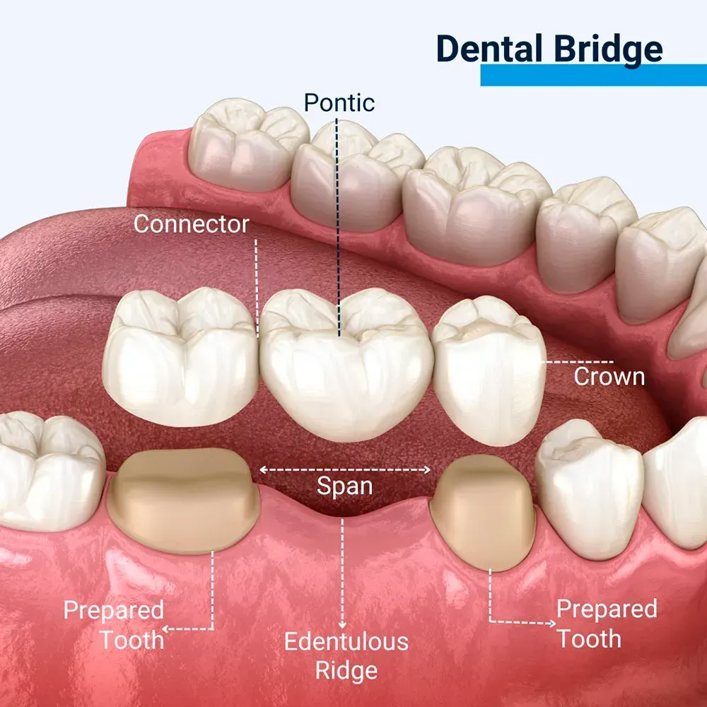 Diagram of a dental bridge showing a false tooth held in place by crowns on adjacent teeth.