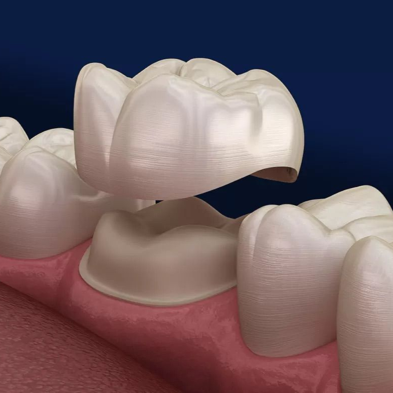 fix chipped front tooth