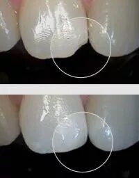 fix chipped front tooth