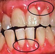 Periodontal Disease