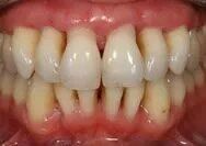 Periodontal Disease