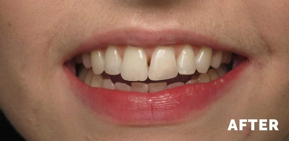 Close-up of a mouth smiling, teeth are white and lipstick is red. 