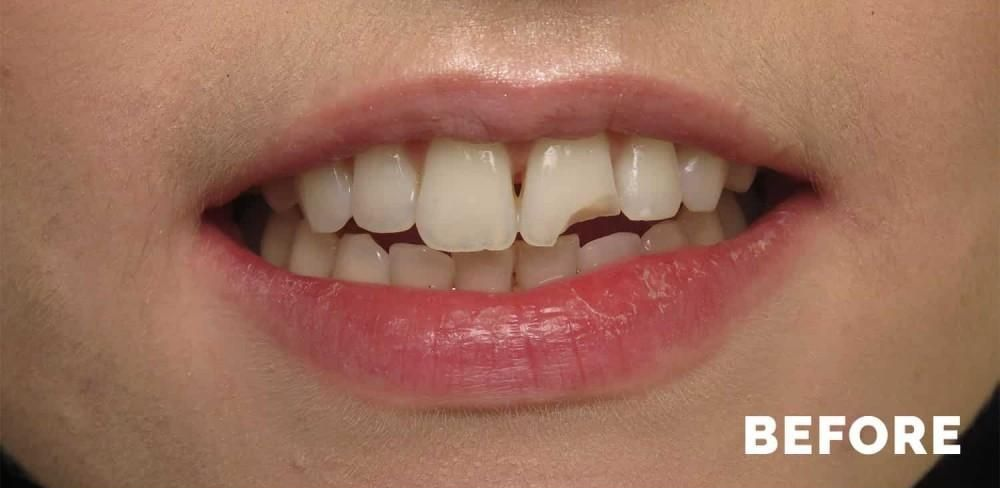 Close-up of a mouth with a chipped front tooth, labeled 