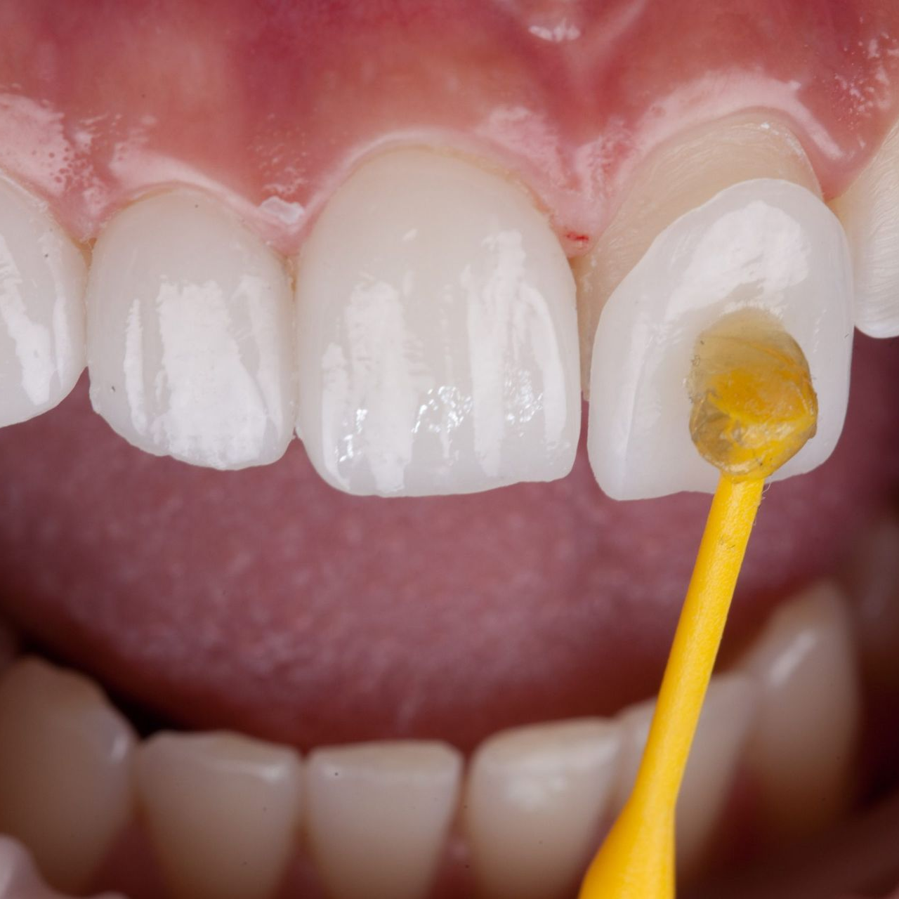 fix chipped front tooth