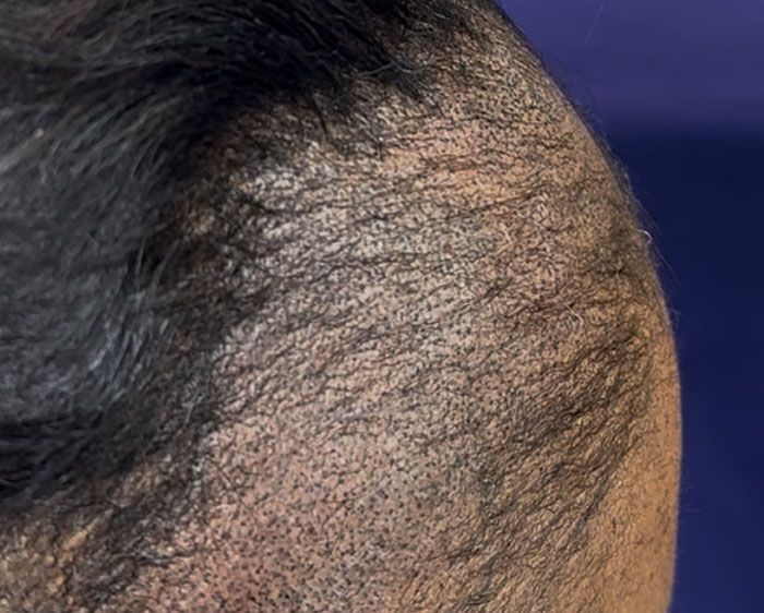 Close-up of scalp with thinning hair and visible skin, dark and light colors present.