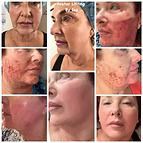 Collage of close-up facial photos showing red, irritated skin and visible blemishes.
