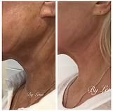Before-and-after side profile showing a neck wrinkle reduction and smoother skin adjustment