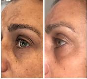 Side-by-side close-up of an eye before and after treatment, showing reduced under-eye puffiness and discoloration