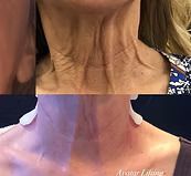 Before-and-after close-up of a neck showing prominent wrinkles and smoother skin.
