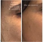 Before-and-after close-up of skin; left shows dark spots, right shows smoother skin after treatment.