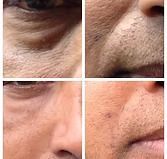 Close-up collage of facial skin before and after treatment, showing visible improvement in texture and spots