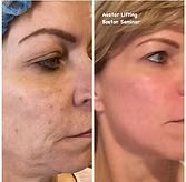 Side-by-side facial profile comparison showing reduced wrinkles and tighter skin after treatment