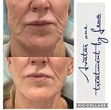 Close-up before-and-after face comparison showing reduced wrinkles around the mouth and chin.