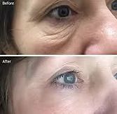 Before-and-after close-up of an eye area, showing reduced under-eye wrinkles and a smoother, brighter appearance.