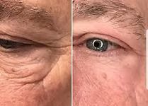 Side-by-side close-up of a wrinkled closed eye and an open eye on a face in warm light.