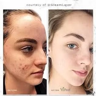 Side-by-side face close-up showing acne before and after treatment, with clearer skin on the right