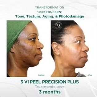 Before-and-after profile photos showing reduced acne marks after 3 VI Peel Precision Plus treatments