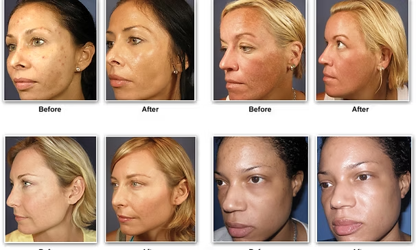Collage of women’s face photos labeled before and after, showing skin tone changes from lighter to darker.
