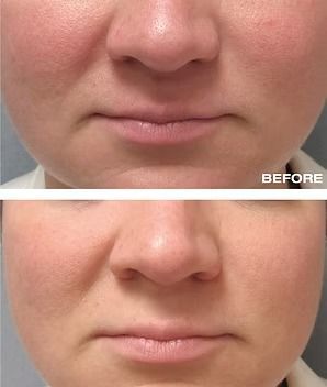 Before-and-after close-up of lower face showing nose and lips, with a softer appearance in the bottom image.