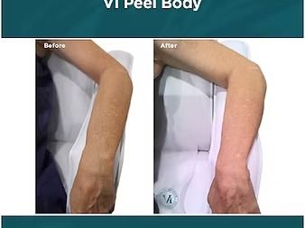 Before-and-after photos of an arm showing skin-smoothing results after a Vi Peel Body treatment.