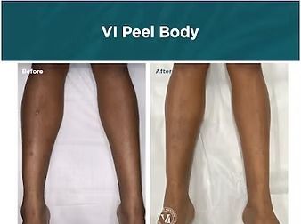 Before-and-after photo of lower legs showing lighter skin tone after treatment