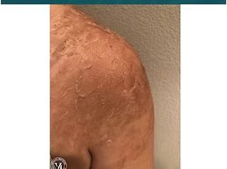 Close-up of a person's shoulder and upper arm with dry, rough, scaly skin and peeling patches