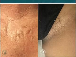 Side-by-side close-ups of skin showing a rough, lighter patch and a darker, smoother patch