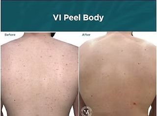 VI Peel Body before-and-after comparison showing clearer skin on the back