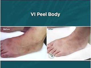 Before-and-after photo of a foot with a VI peel body treatment, showing reduced discoloration.
