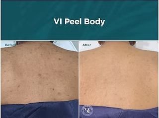 Before-and-after back skin showing reduced dark spots after VI Peel Body treatment