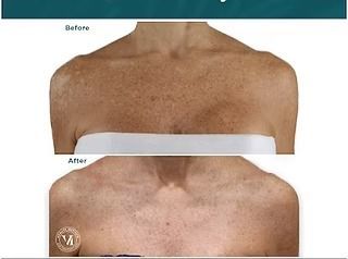 Before-and-after close-up of upper back showing reduced dark spots and smoother skin after treatment